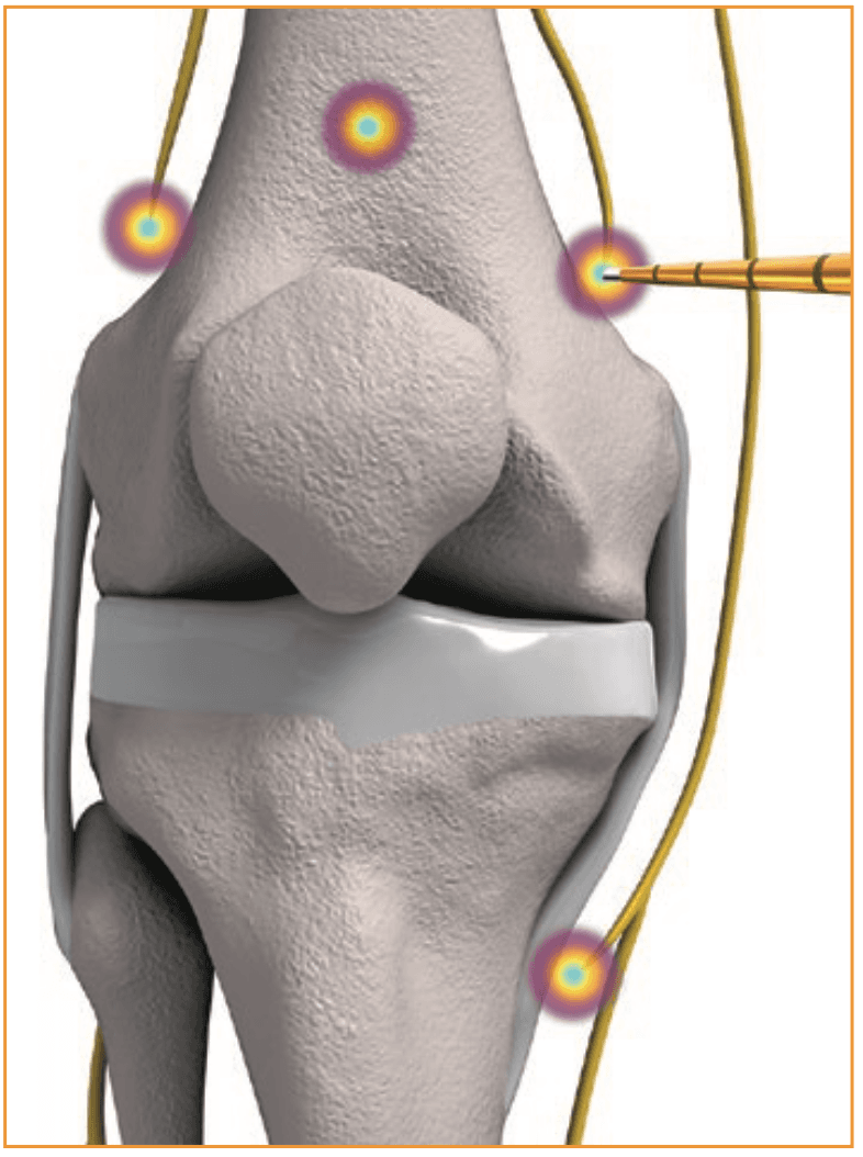 Anatomische Darstellung der Kniedenervation mit COOLIEF
